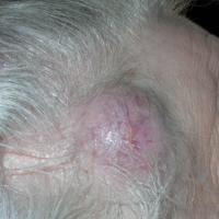 Metastatic adenocarcinoma