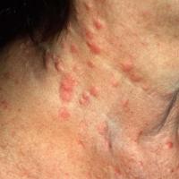 
	Metastatic lung cancer