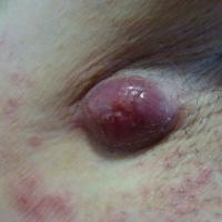 
	Metastatic lung cancer

	Copied with kind…