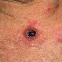 
	Metastatic cholangiocarcinoma