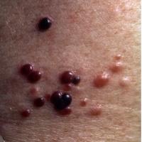 
	Metastatic melanoma - distant spread