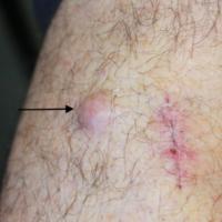 
	Metastatic melanoma - local spread&nbsp;