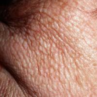 
	Solar elastosis close-up

	Cobblestone…