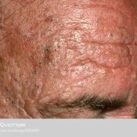 
	Solar elastosis with comedones