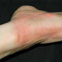 
	Solar urticaria
Copied with kind permission…
