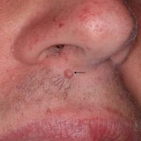
	Solitary circumscribed neuroma 