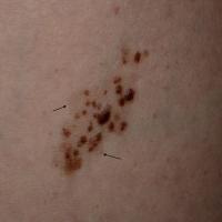 
	Speckled lentiginous naevus

	Arrows denote the…