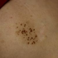 
	Speckled lentiginous naevus