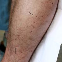 
	Speckled lentiginous naevus

	Arrows denote the…