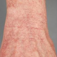 
	Generalised essential telangiectasia&nbsp;
