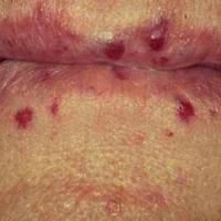 
	Hereditary haemorrhagic telangiectasia
