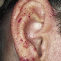 
	Hereditary haemorrhagic telangiectasia