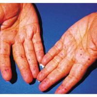 
	Hereditary haemorrhagic telangiectasia