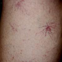 
	Telangiectases on the legs
