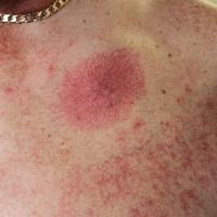 
	Spider naevi secondary to alcohol-related liver…