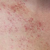 
	Unilateral naevoid telangiectasia - close-up