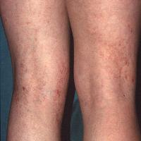 
	Angioma serpiginosum