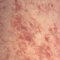 
	Angioma serpiginosum