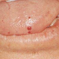 
	Hereditary haemorrhagic telangiectasia