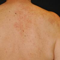 
	Unilateral naevoid telangiectasia

	Copied with…