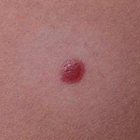 Same lesion