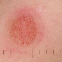 Same lesionAtypical vessels and shiny white…