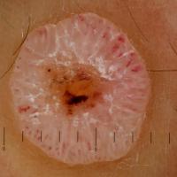 Spitz naevus - same lesionThe typical dermoscopic…