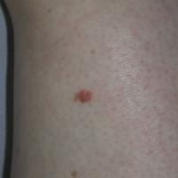 
	An amelanotic melanoma
	
	Can mimic Spitz…