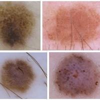 Comparison - common melanocytic naevi and Spitz…