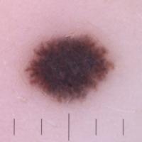 Dermoscopic appearance of previous figure&nbsp;