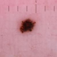 Dermoscopic image of previous figureGlobules and…