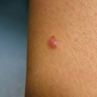 
	Spitz naevus on the forearm