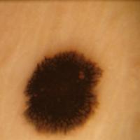 
	Dermoscopic appearance of previous…