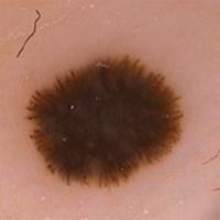 Dermoscopic appearance of previous…