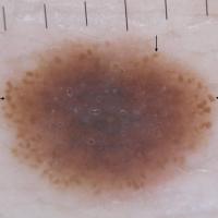 
	Dermoscopic appearance of previous…