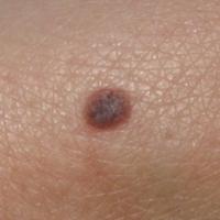 Pigmented Spitz naevus&nbsp;

	New lesion on…