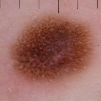 Dermoscopic appearance of previous…
