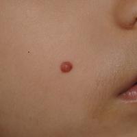 
	Spitz naevus on the cheek
	
	Copied with kind…