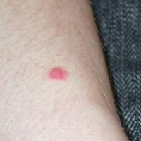 
	Spitz naevus on the forearm