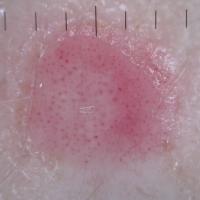 
	Dermoscopic appearance of previous…