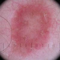 
	Dermoscopic appearance of…