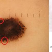 Comparison
The peripheral globules in Spitz…
