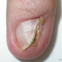 Nail SCC
Destruction of the nail arising from…