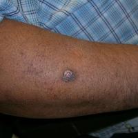 Well-differentiated SCC in skin of colourCopied…