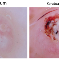 Comparison - molluscum contagiosum (left) and SCC…