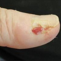 SCC of the nailCopied with kind permission from…