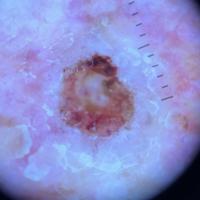 Dermoscopic appearance of same lesionThe edge…