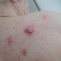 Squamous cell carcinomaCopied with kind…