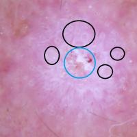 Dermoscopic appearance of pervious…