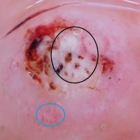 Dermoscopic appearance of previous figureKeratin…